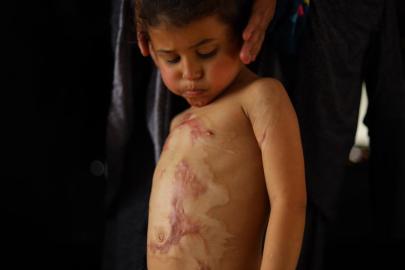 Katil İsrail'in kısıtlamaları nedeniyle Gazze'de yanık hastaları için tıbbi malzemeler tükenmek üzere